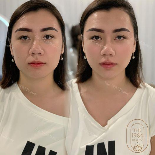 Một case điển hình của combo : Botox thon gọn hàm + làm cằm thì sẽ thay đổi form mặt của bạn thế nào 