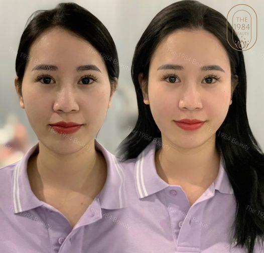 NHIỀU NGƯỜI TIÊM FILLER LÀM ĐẦY THÁI DƯƠNG VỀ BỊ ĐAU ĐẦU SUỐT !